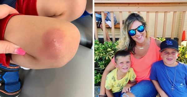 SouthCoast Health bug bite 